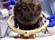 Stereotactic Brain Tumor Surgery